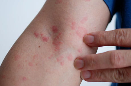 An arm with hives